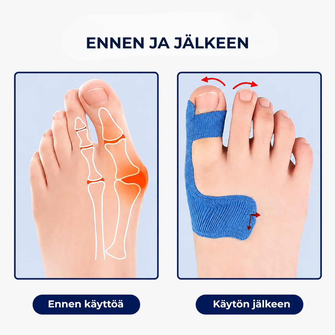AlignTape™ | Valmiiksi leikattu elastinen kinesioteippi hallux valgus -tukeen